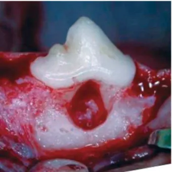 Figure 1- Clinical aspect of Class II furcation defect (5x  2 mm)