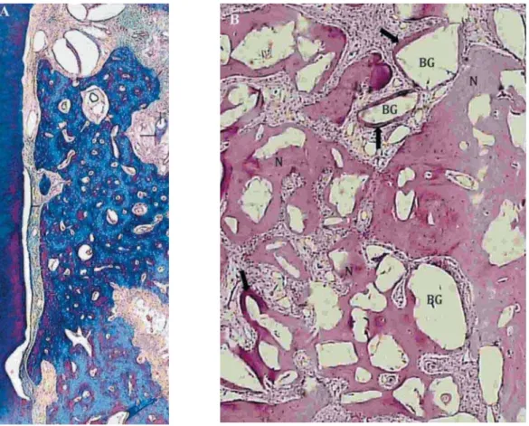 Figure 4- A) Photomicrograph of a mesiodistal histologic section of Class II furcation lesion platelet-rich plasma + bioactive  glass + guided-tissue regeneration (PRP+BG+GTR) 90 days after treatment defect (Masson Trichrome staining, original   += &gt;?  