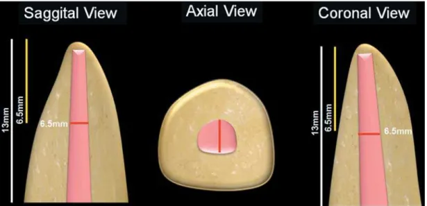 Figure 1- Schematic representation of sectioning root method and post length, showing the sagittal, axial, and coronal  views 