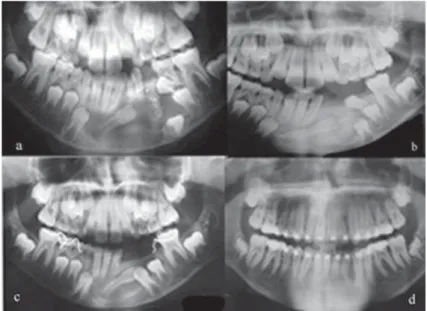 Figure 2 - Panel of panoramic radiographs. (a) Unilocular osteolytic cystic lesion with sclerotic border associated to lateral  incisor