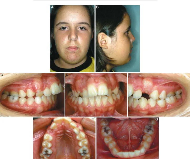 Figure 1- Pretreatment extraoral (A and B) and intraoral (C-G) photographs (parents authorized the publication of these  pictures) A BCDF GE A B