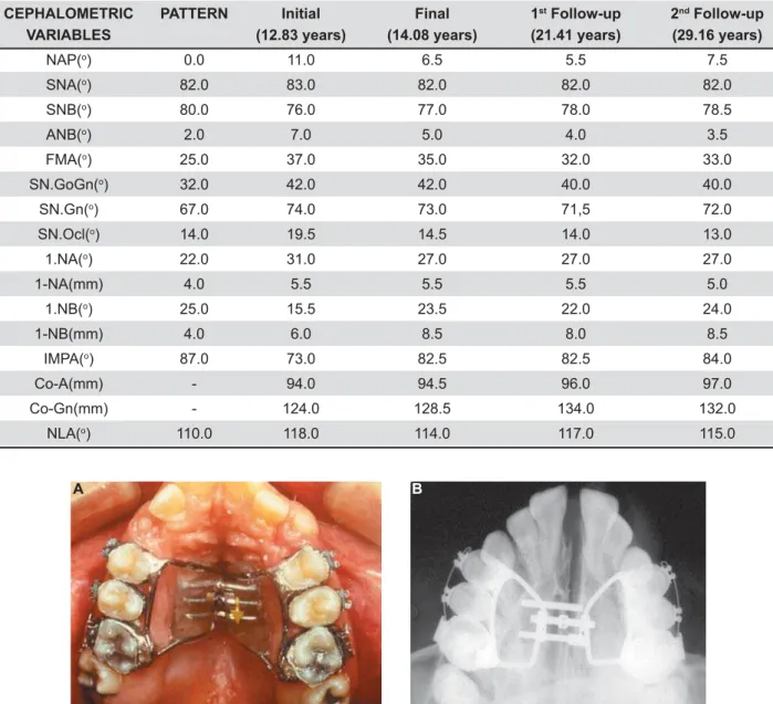 Figure 3- Intraoral aspects. Occlusal view showing the Haas-type expansion appliance installed (A) and the radiographic  aspect (B) CEPHALOMETRICVARIABLES PATTERN Initial  (12.83 years) Final (14.08 years) 1 st  Follow-up (21.41 years) 2 nd  Follow-up(29.1