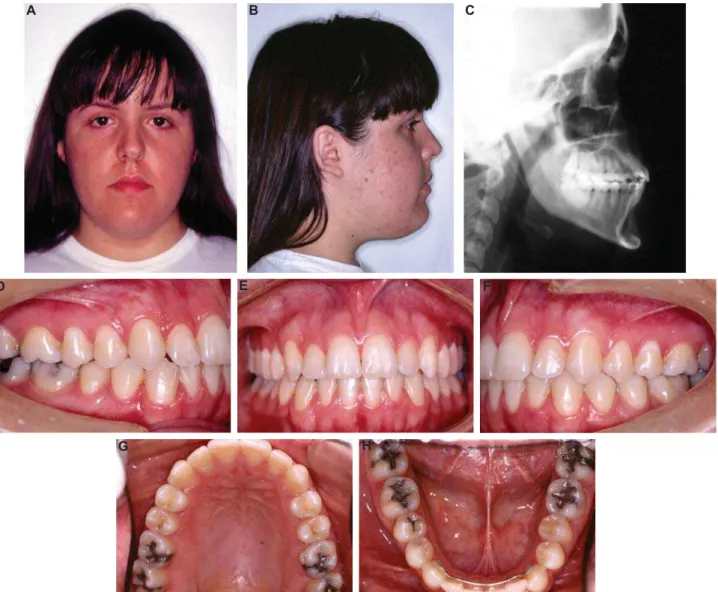 Figure 6- Final lateral cephalograms (A) and panoramic radiograph (B)