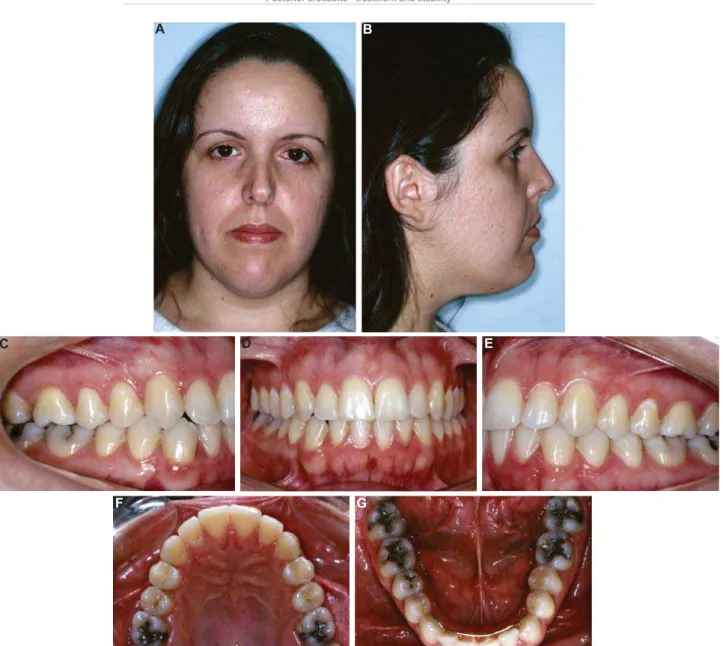 Figure 8- 14-year posttreatment extraoral (A and B) and intraoral (C-G) photographs (parents authorized the publication  of these pictures)