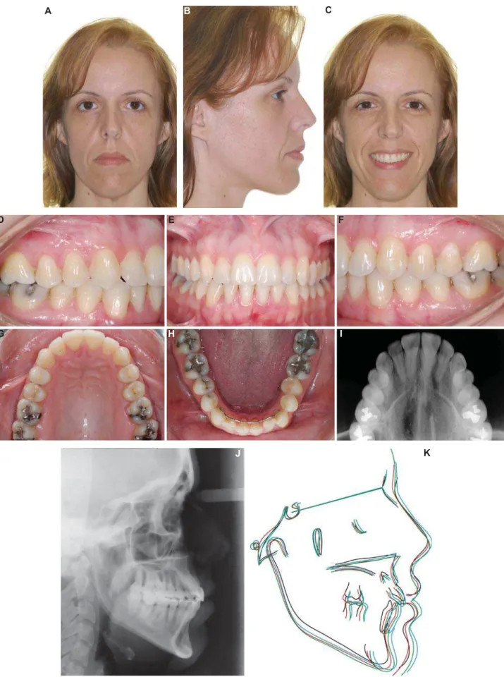 Figure 10- 22-year posttreatment extraoral (A and C) and intraoral (D-H) photographs. Lateral cephalograms (J), occlusal   !  &#34; &#34;#