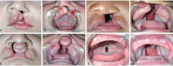 Figure 2- A and B – Pre- and postoperative aspect of cheiloplasty (surgical repair of the lip); C and D – Pre- and postoperative  aspect of palatoplasty (surgical repair of the palate)