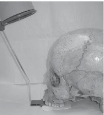 Figure 2- Occlusal radiographs with mini-implants placed Figure 1- for standardized occlusal radiograph