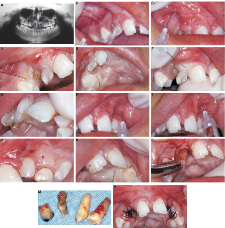 Figure 2- Patient with a complete bilateral cleft lip and palate:A: Panoramic radiograph showing residual teeth in the right   &#34;$    % &amp; '&#34; * +! % &amp; '&#34; * + % &amp;'&#34;+# %&amp;'&#34;+ /  6  %&amp; '&#34; * +&lt; 