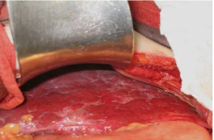 FIGURA 3 - Bocelamento da superfície do fígado na esquistossomose (VOIETA, 2007). 