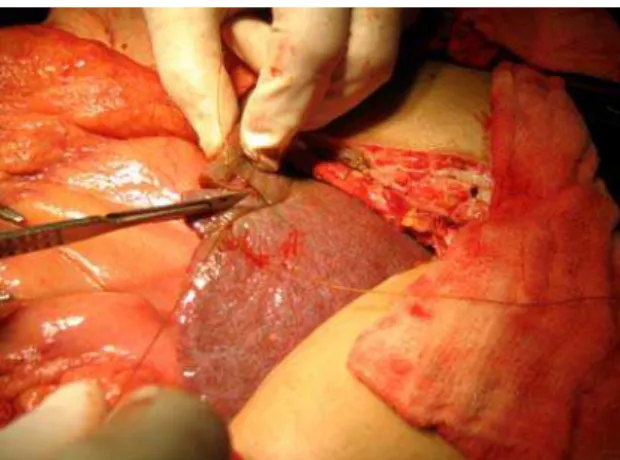 FIGURA 8- Aspecto macroscópico do fígado e realização de biópsia hepática  (VOIETA et al, 2010) 