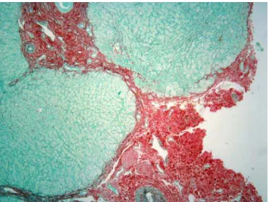 FIGURA 10 - Biópsia hepática em lâmina histológica. Coloração Picrossírius vermelho –  10x