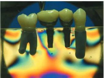 Figure 2-  Vertical  single  point  load  (5  kgf)  on  the  irst  molar (model with the second molar replica)