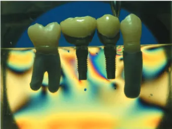 Figure 6- Vertical single point load (5 kgf) on the second  premolar (model with the second molar replica)
