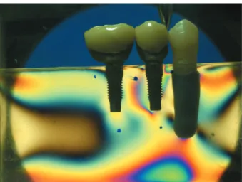 Figure 7- Vertical single point load (5 kgf) on the second  premolar (model without the second molar replica)
