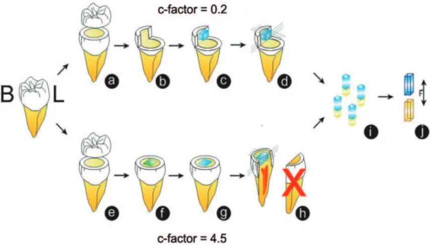 Figure 2- a- Flat Surface cavity model – removal of occlusal enamel; b- Cavity preparation and removal of all the walls,  except the vestibular wall (control); c- Resin block fabrication; d- Cuts to obtain specimens for microtensile test; e- Class  I cavit