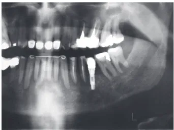 Figure 2- Panoramic radiography showing diffuse  radiolucent area in the left mandibular body region