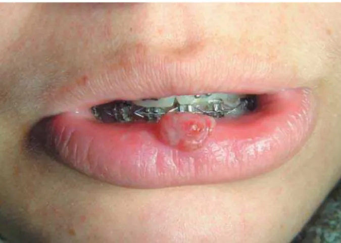 Figure 1- GG on lip associated with trauma by orthodontic  appliance