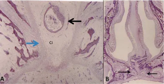 Figure 5- Horn cyst (blue arrow) in region of submucosa and bilateral nasopalatine duct entrance (black arrows) (X3.2 