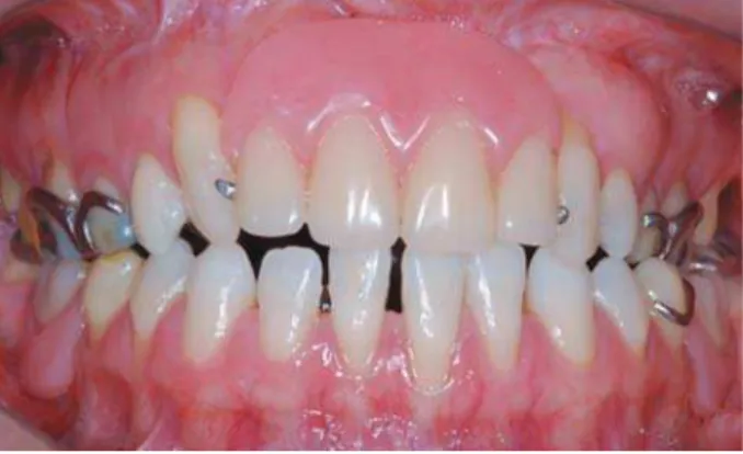 Figure 4- Cleft area rehabilitated with removable partial  denture