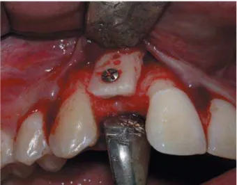 Figure 8- Re-graft area of the cleft area for dental implant