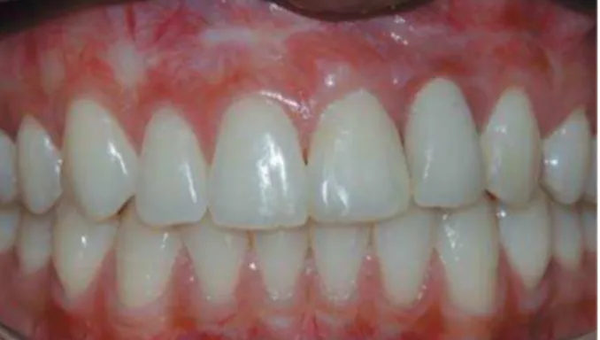 Figure 9- Implant in the left lateral incisor