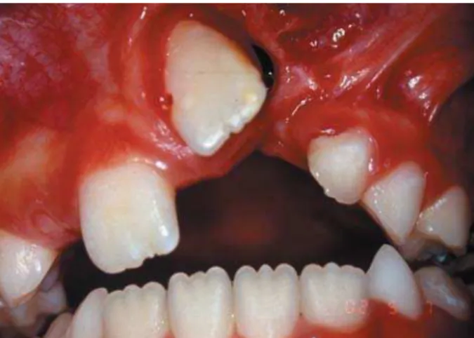 Figure 11- Presence of frenula, gingival recession on  teeth adjacent to the cleft and generalized dental plaque