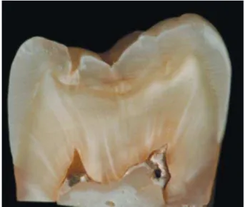 Figure 2- Appearance of Group 1 (MTA Fillapex) after 3  months. Color stability of MTA Fillapex sealer within its  mass and absence of dentinal staining