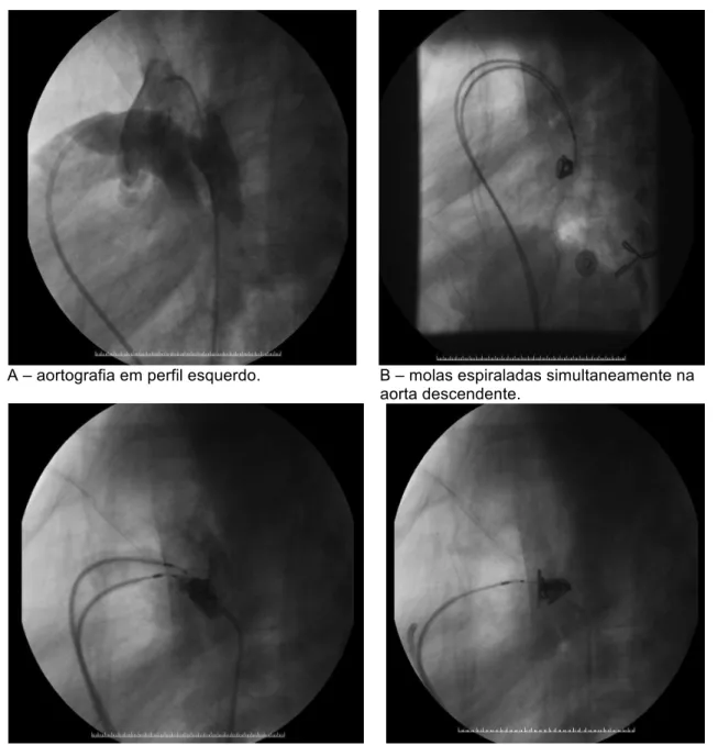 FIGURA 5 – Imagem angiográfica da técnica de implante do dispositivo mola de  liberação controlada no interior do canal arterial, por via anterógrada 