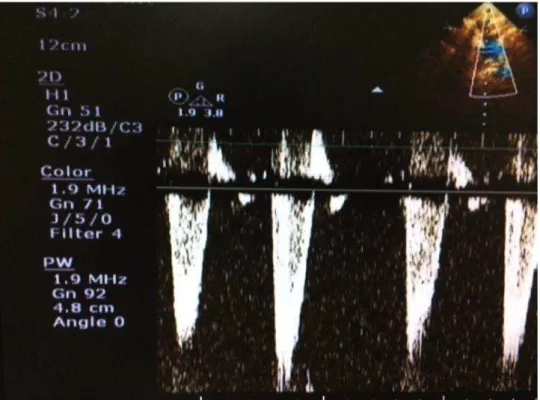 FIGURA  7  -  Imagem  ecocardiográfica  doppler  com  mapeamento  de  fluxo  em  cores da velocidade de fluxo no istmo aórtico 