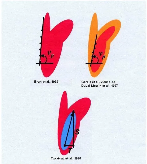 Figura 3 – Desenhos ilustrativos dos principais métodos de medida da velocidade do  vórtice ventricular mitral a partir da rampa formada ao modo M em cores (MC)