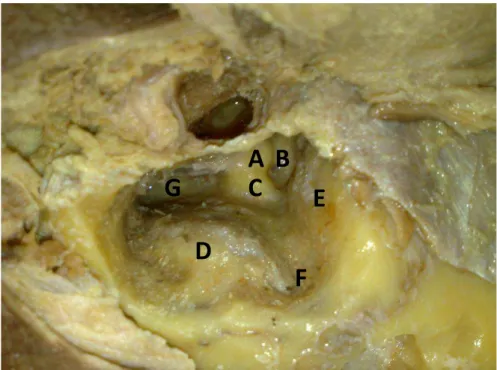 FIGURA 4 - Vista lateral de peça anatômica que permite a identificação dos  componentes da mastoidectomia esquerda 