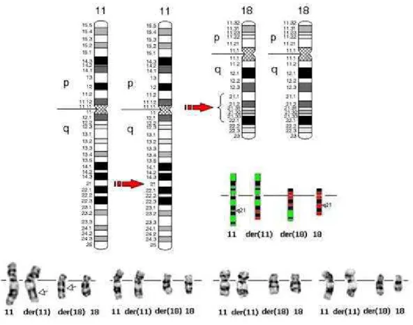 FIGURA 2 - Ideograma e cariótipos demonstrando a translocação entre   o cromossomo 11 (API2 11q21) e o cromossomo 18 (MLT 18q21) 