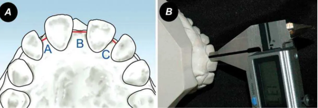 Figure 1- (1A) Sites where diastema widths were measured. A: Right lateral diastema; B: midline diastema; C: Left lateral  diastema