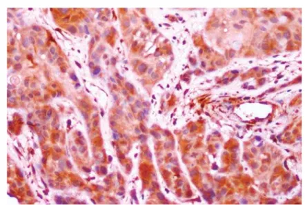 Figure 2- Oral squamous cell carcinoma (OSCC) showing type 2 cord like pattern of invasion (S100 A4, 20x)