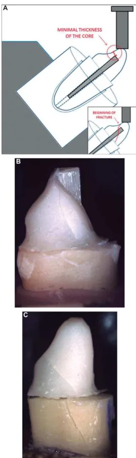 Figure 3 shows the relation between the force  applied and the deformation through graphics of  fracture resistance tests for groups AS, P, and C,  generated by the universal testing machine