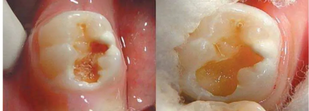 Figure 2- Clinical aspect of cavity before and after removal of carious tissue with chemo-mechanical caries removal