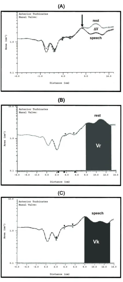 Figure  2-  Tracing A shows two superimposed rhinograms obtained during VP rest and activity