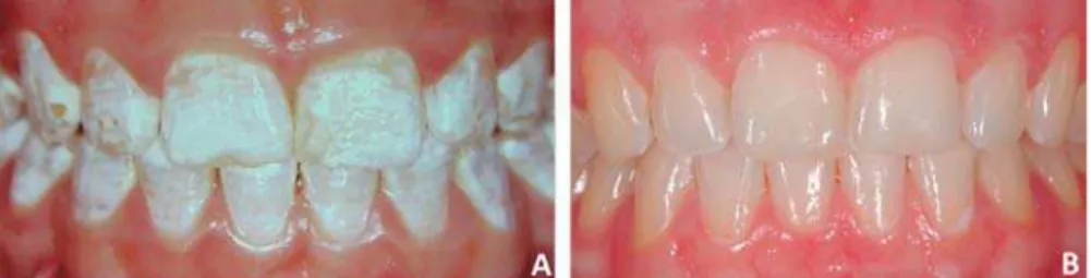 Figure 2- A: A 12-year-old girl had idiopathic white enamel demineralization of both the maxillary and mandibular teeth; B: 