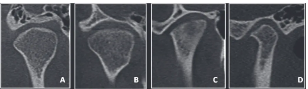 Figure 2- Cone-beam computed tomography images  of temporomandibular joint (coronal view) showing  advanced destruction of mandibular condyle