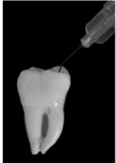 FIGURA 3 – Injeção da substância para contraste radiográfico (Hypaque) no canal  mésio-vestibular