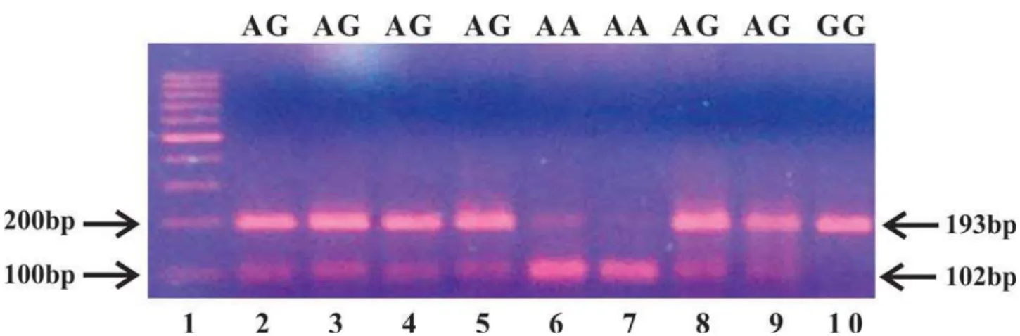 Figure 1- PCR-RFLP of EGF+61 A>G polymorphism. Agarose gel electrophoresis of EGF DNA fragments stained with  ethidium bromide