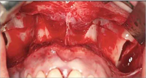 Figure 1- Subtotal Le Fort I osteotomy with zygomatic pillar step