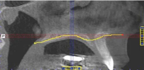 Figure 2- Demarcation of hard palate curvature with the aid of “irregular” tool