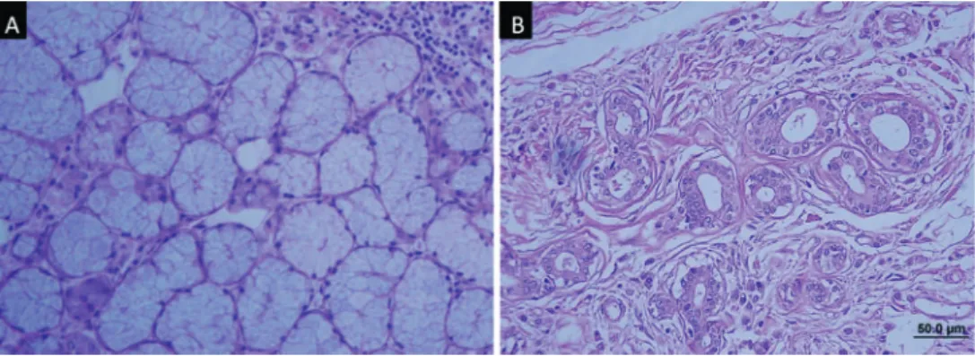Figure 1- A: Normal gland – 26 years old (Group I). Preserved acini and absence of duct-like structures (DLS) are observed; 