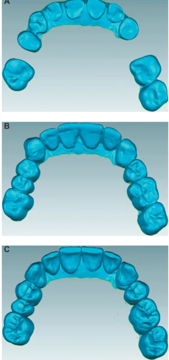 Figure 2-  Example of the evaluated virtual models. (A)  Pre-treatment model; (B) Conventional wax-up model; 