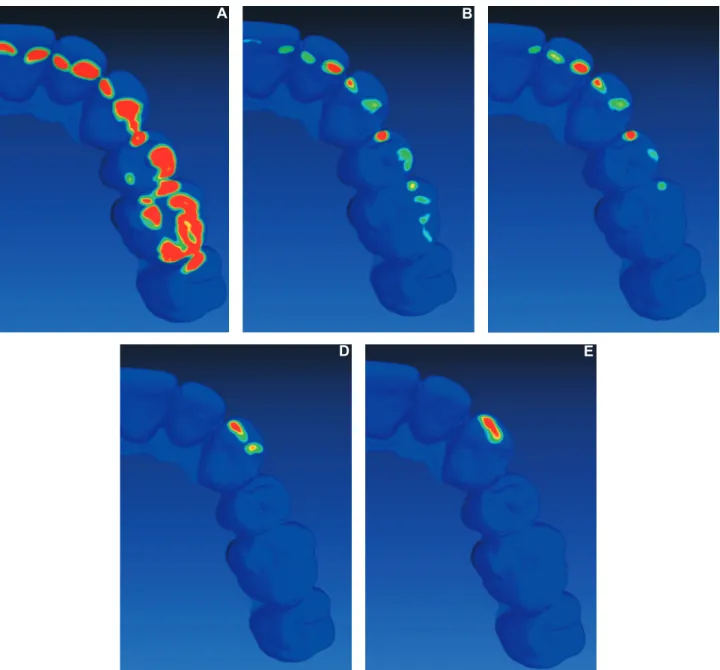 Figure 3-  Example of virtual simulation of lateral movement. (A) Maximal intercuspation; (B) 0.5 mm excursion; (C) 1.0 mm  excursion; (D) 2.0 mm excursion; (E) 3.0 mm excursion; red colour indicates the existing contacts