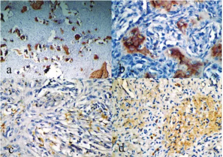 Figure 4-  a) Peripheral ossifying ibroma (POF) showing osteopontin (OPN) expression in calciication resembling bone  and cementum under lower magniication; b) The bony trabeculae expressing OPN in 40x; c) POF showing OPN expression  in stromal cells (40x)