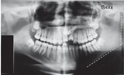 Table 1- Frequency of dental anomalies (per tooth) in the FXS and control groupsFigure 1- Panoramic radiography with the mandibular angle lines