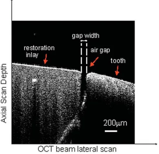 Figure 5- A representative optical coherence tomography (OCT) scan of a tooth from the direct group before cementation