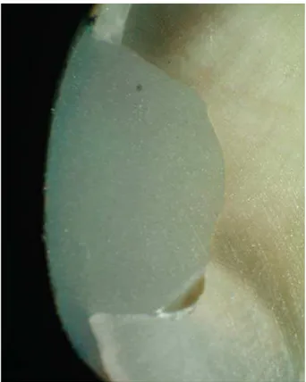 Figure 4- Photomicrograph of gamma group (laser) showing  micro leakage (score 3)